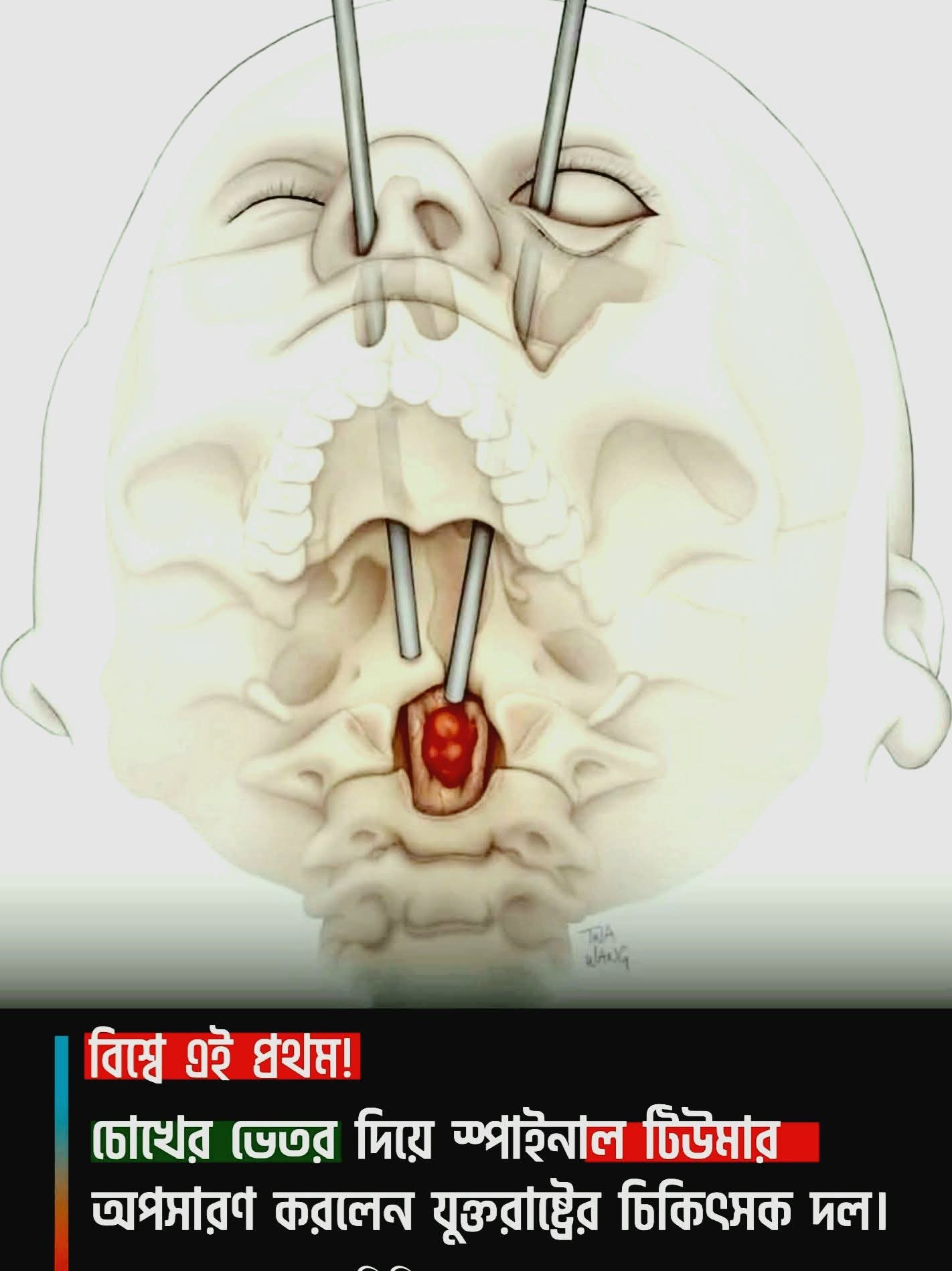 Tumor operation