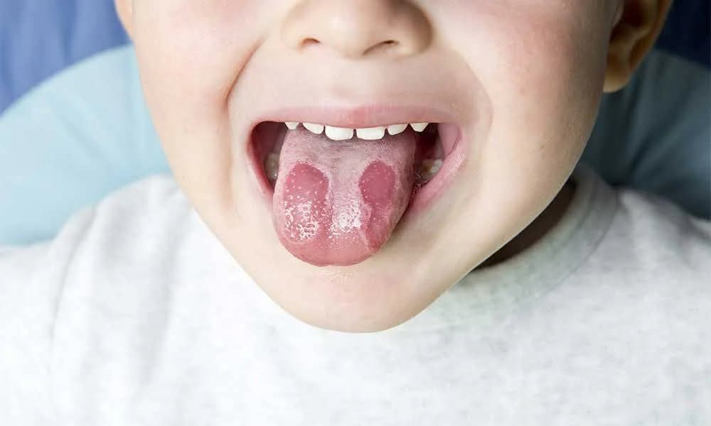 Geographic tongue