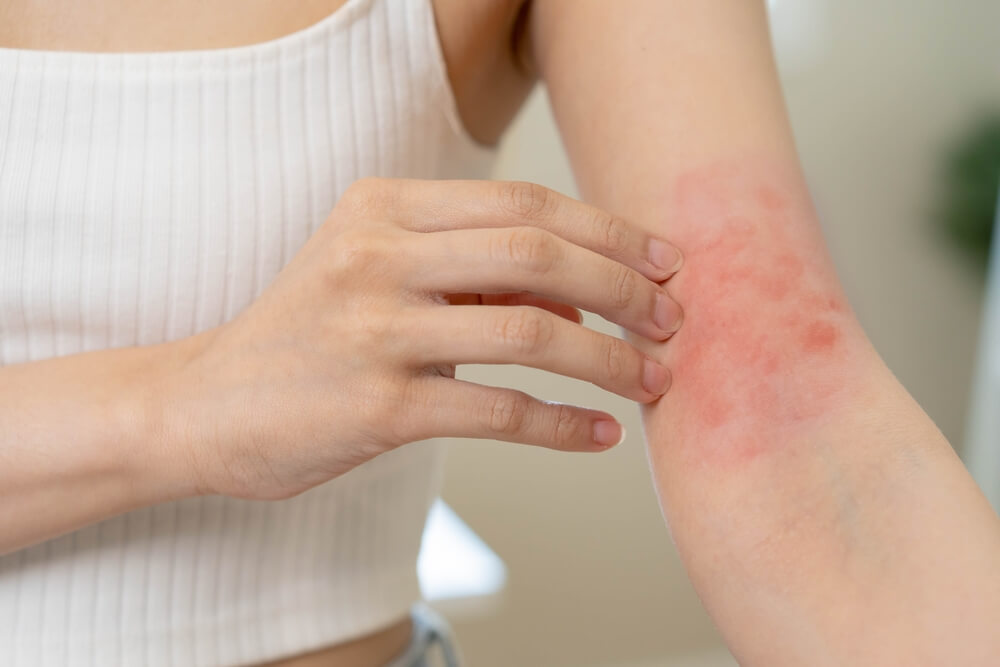 skin rash